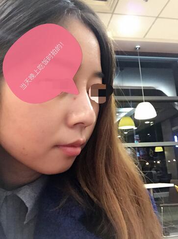 做了玻尿酸注射隆鼻 感覺(jué)很不錯(cuò)