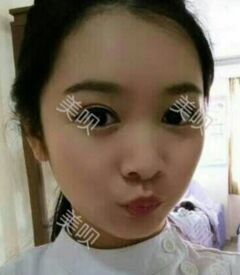 全切雙眼皮讓我眼睛變得更大更有神