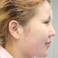 面部吸脂瘦臉后讓我從大餅?zāi)樧兂闪税驼菩臉