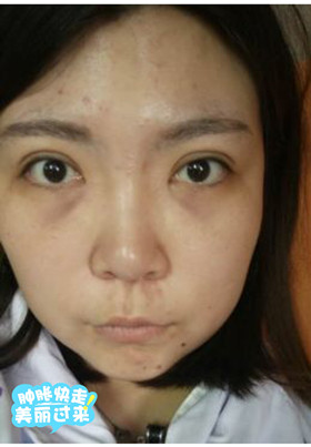 激光去眼袋后，整個人都年輕了不少啊!