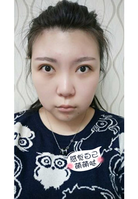 激光去眼袋后，整個人都年輕了不少啊!