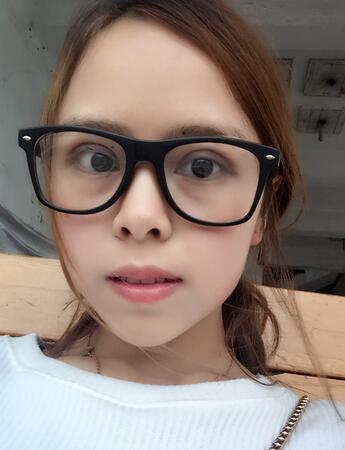 切開雙眼皮恢復(fù)過程 心路分享~