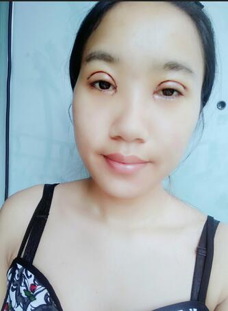 8.15號割的雙眼皮 感謝慕醫(yī)生