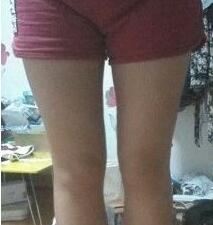 大腿吸脂三個月 瘦了很多