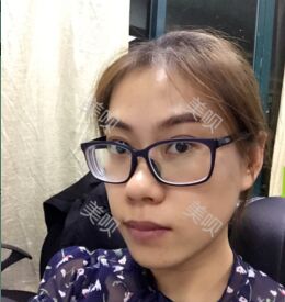 埋埋蛋白線.提升后皮膚緊致了不少也更年輕了