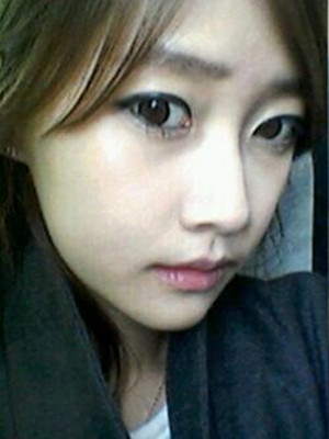 終于做了下頜角磨骨的手術(shù) 北京藝星做的 果還不錯