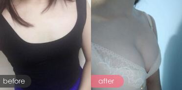 假體隆胸前后對(duì)比圖