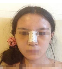 藝美門智和綜合隆鼻，你值得擁有