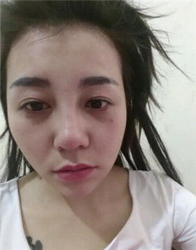 來評(píng)價(jià)一下華美劉琦做的高強(qiáng)度聚焦超聲吧