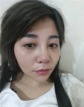 來評(píng)價(jià)一下華美劉琦做的高強(qiáng)度聚焦超聲吧