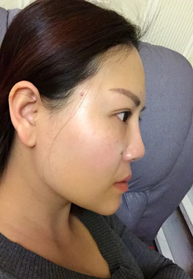 自體脂肪填充面部前后對比圖片，真的美了美了!