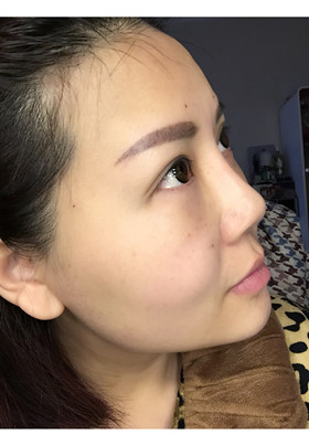 自體脂肪填充面部前后對比圖片，真的美了美了!