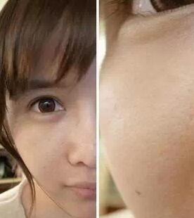 成都玉之光激光嫩膚經(jīng)歷 愛(ài)美的MM一定要看