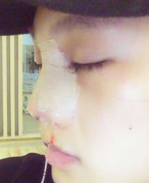 趙煜楠給做的隆鼻整形，看看我鼻子果怎么樣