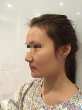 終于做了顴骨內(nèi)推了還是在北京八大處果我放心