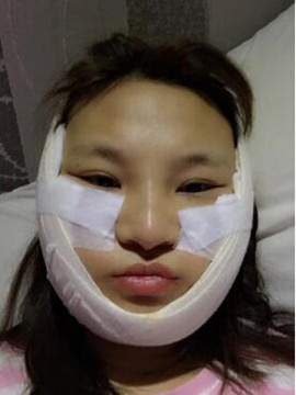 終于做了顴骨內(nèi)推了還是在北京八大處果我放心