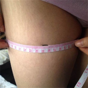 看看我大腿吸脂的前后對比果圖片吧，是東方和諧張準做的