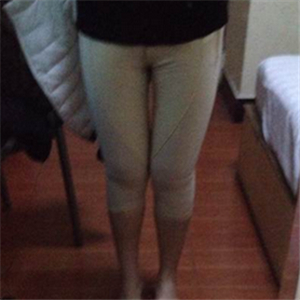 看看我大腿吸脂的前后對比果圖片吧，是東方和諧張準做的