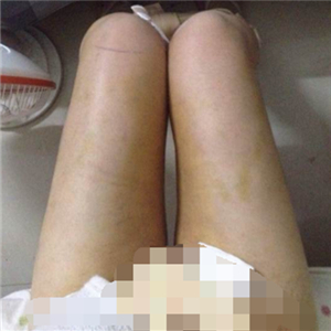 看看我大腿吸脂的前后對比果圖片吧，是東方和諧張準做的