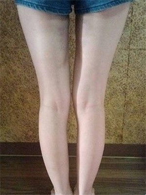 去年東方和諧張準醫(yī)生做的大腿抽脂，分享一下我的前后對比果圖片！