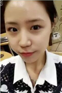 找夏正義做自體脂肪面部填充三個月了，恢復(fù)果很好有對比照片哦~~