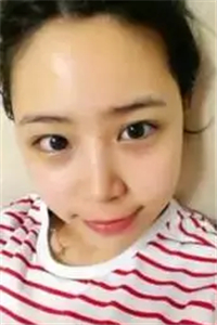 找夏正義做自體脂肪面部填充三個月了，恢復(fù)果很好有對比照片哦~~