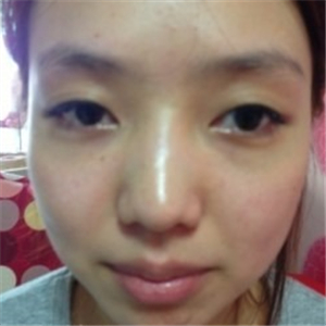 米揚(yáng)麗格夏正義做雙眼皮果怎么樣？看看我的前后對比果圖片吧！