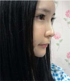 大家都來評(píng)價(jià)一下劉琦做的玻尿酸隆鼻果 還不錯(cuò)吧