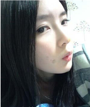 大家都來評(píng)價(jià)一下劉琦做的玻尿酸隆鼻果 還不錯(cuò)吧