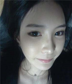 大家都來評(píng)價(jià)一下劉琦做的玻尿酸隆鼻果 還不錯(cuò)吧