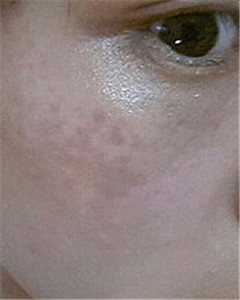 華美杜姜做的激光祛斑 果好不好你來(lái)看