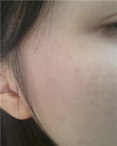 華美杜姜做的激光祛斑 果好不好你來(lái)看