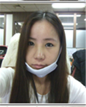 下頜角整形做完變小臉 孫麗君醫(yī)生棒棒噠