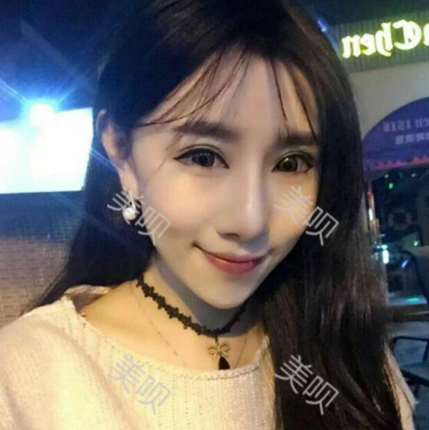 我自體脂肪面部填充后甩掉了干癟臉重回18歲了