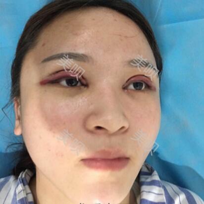 在成都藝美匯做的切開雙眼皮+開眼角果還可以吧