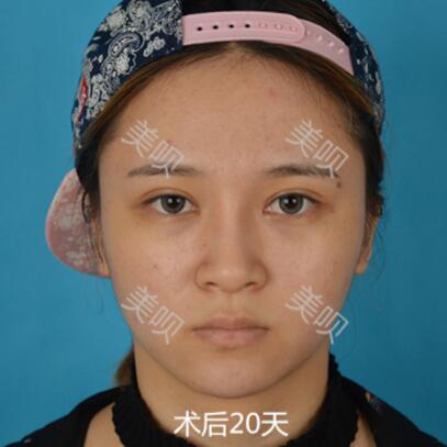 在成都藝美匯做的切開雙眼皮+開眼角果還可以吧