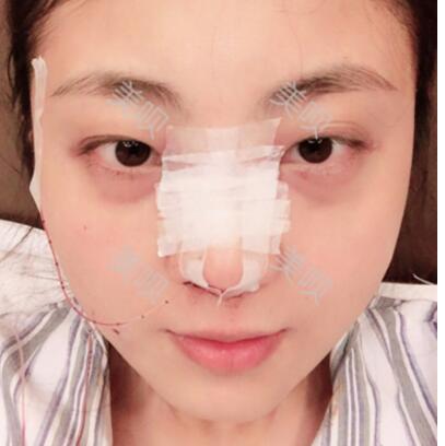 我的玻尿酸隆鼻后大家來看看果怎么樣