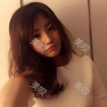 我的玻尿酸隆鼻后大家來看看果怎么樣