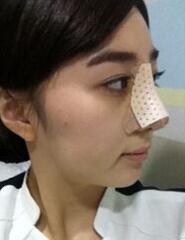 深圳希思崔院長(zhǎng)隆鼻整形 擺脫了豬妹妹的稱(chēng)號(hào)