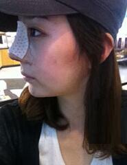 深圳希思崔院長(zhǎng)隆鼻整形 擺脫了豬妹妹的稱(chēng)號(hào)