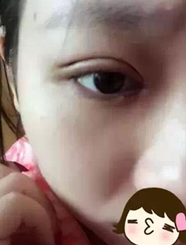 深圳希思做的雙眼皮+開眼角 感謝楊醫(yī)師！