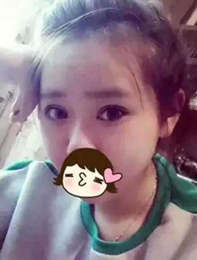 深圳希思做的雙眼皮+開眼角 感謝楊醫(yī)師！