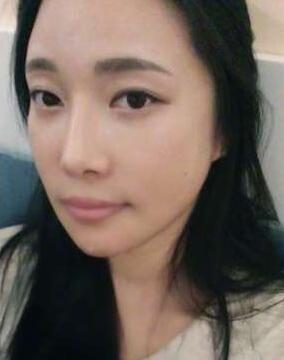 柳大烈給我做的改臉型手術(shù) 求圍觀！