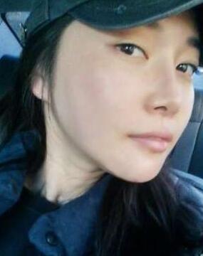 柳大烈給我做的改臉型手術(shù) 求圍觀！