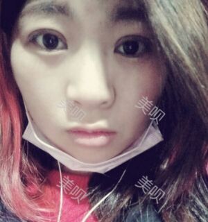 合肥壹加壹王大勇做的切開雙眼皮分享給大家