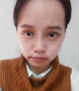 全切雙眼皮+去脂肪，終于擺脫小眼睛了