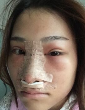 硅膠隆鼻還墊鼻尖了，甘泉涌做的果真的很好喲