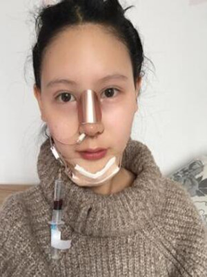 成都天使之翼做隆鼻整形改變了我的塌鼻子 果真的很不錯(cuò)