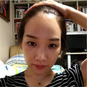 去年在格萊美做了頭發(fā)種植，看看前后對(duì)比和恢復(fù)果照片吧~~