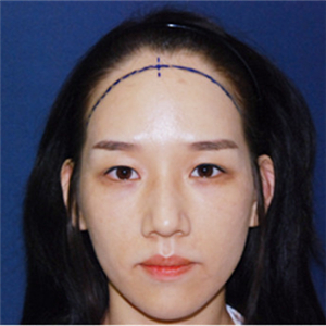 去年在格萊美做了頭發(fā)種植，看看前后對(duì)比和恢復(fù)果照片吧~~